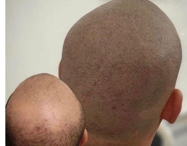 PMU in Braunschweig - Trichopigmentierung ganze Kopfhaut bei Sense of Beauty