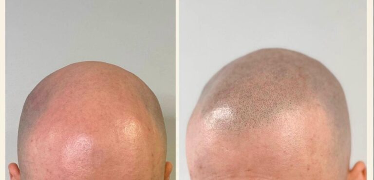 PMU in Braunschweig - Trichopigmentierung Teilbereich von Sense of Beauty